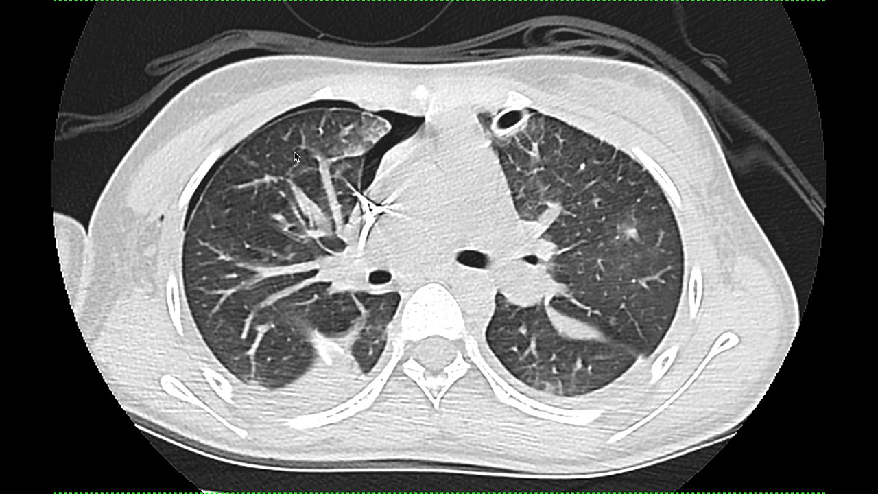 Atelectasia, contusão pulmonar ou COVID19???