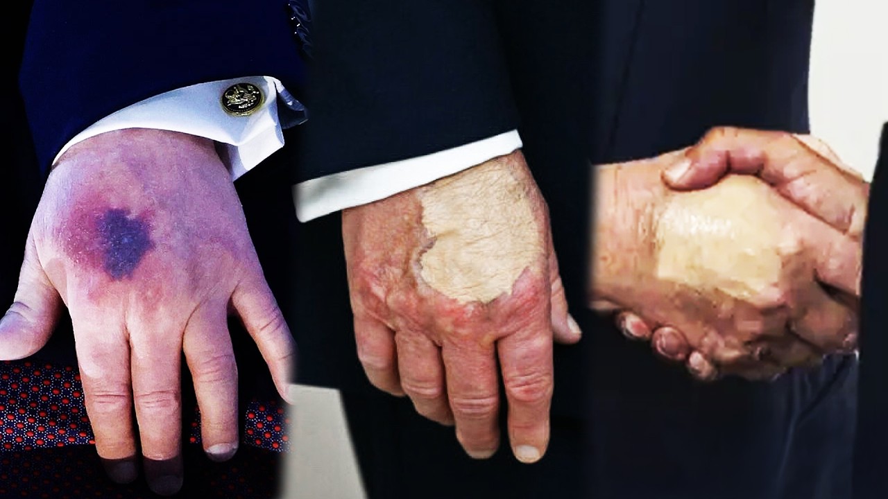 Trump covers rotting hand with even more makeup