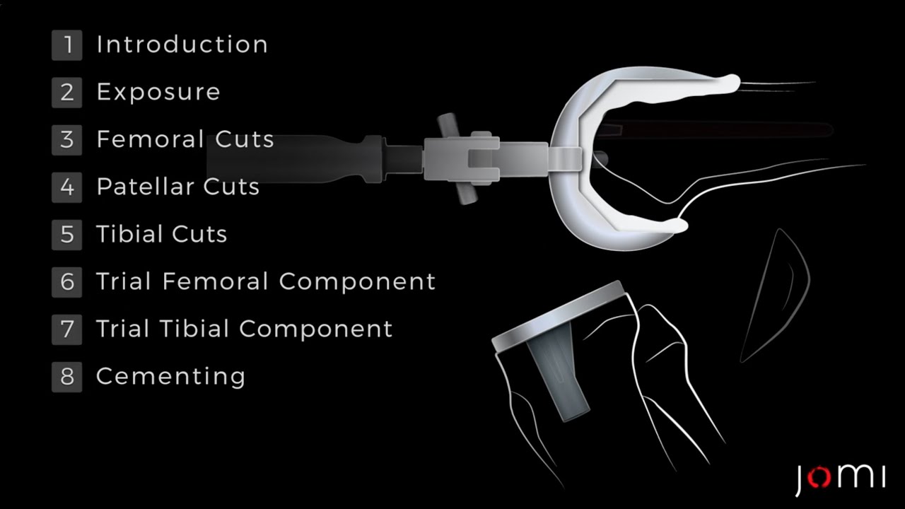 Procedure Steps: Posterior Cruciate-Retaining Total Knee Arthroplasty