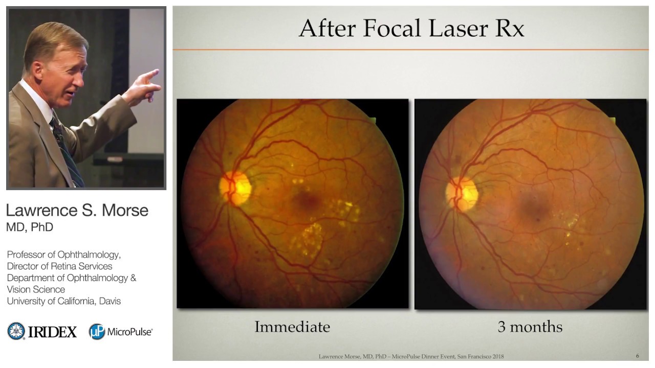 Management of Diabetic Macular Edema with MicroPulse Laser Therapy