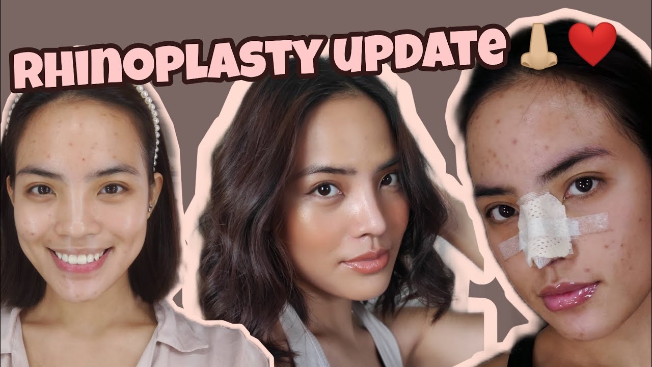 RHINOPLASTY UPDATE AFTER 3 MONTHS! by CHASE