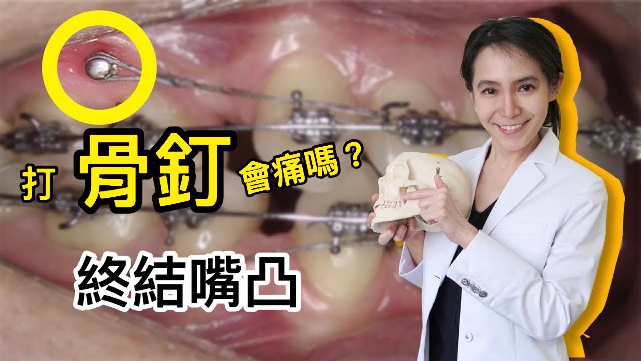 打骨釘會痛嗎？矯正骨釘：戴牙套終結嘴凸的最大功臣｜林榆芩