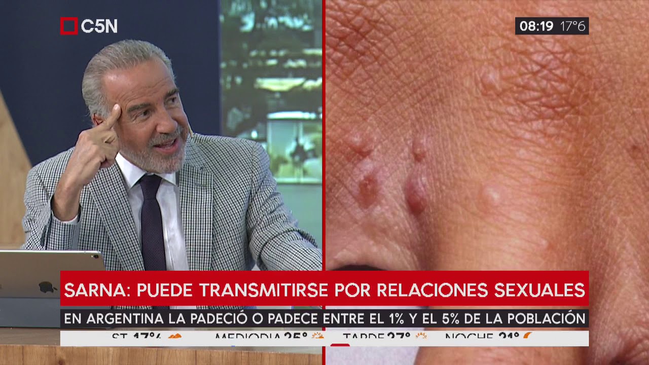 El consultorio del Dr. Capuya: ¿Cómo se contagia la sarna y cuál es el tratamiento?