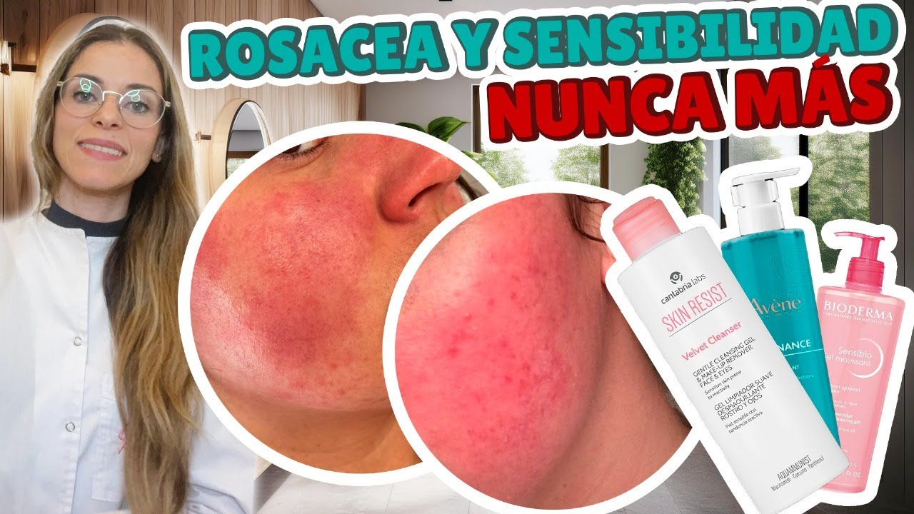 ELIMINA LA ROSÁCEA PARA SIEMPRE