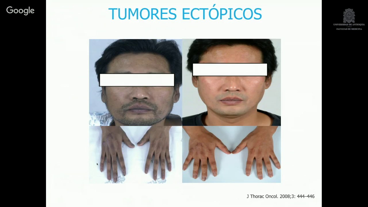 Síndrome de Cushing