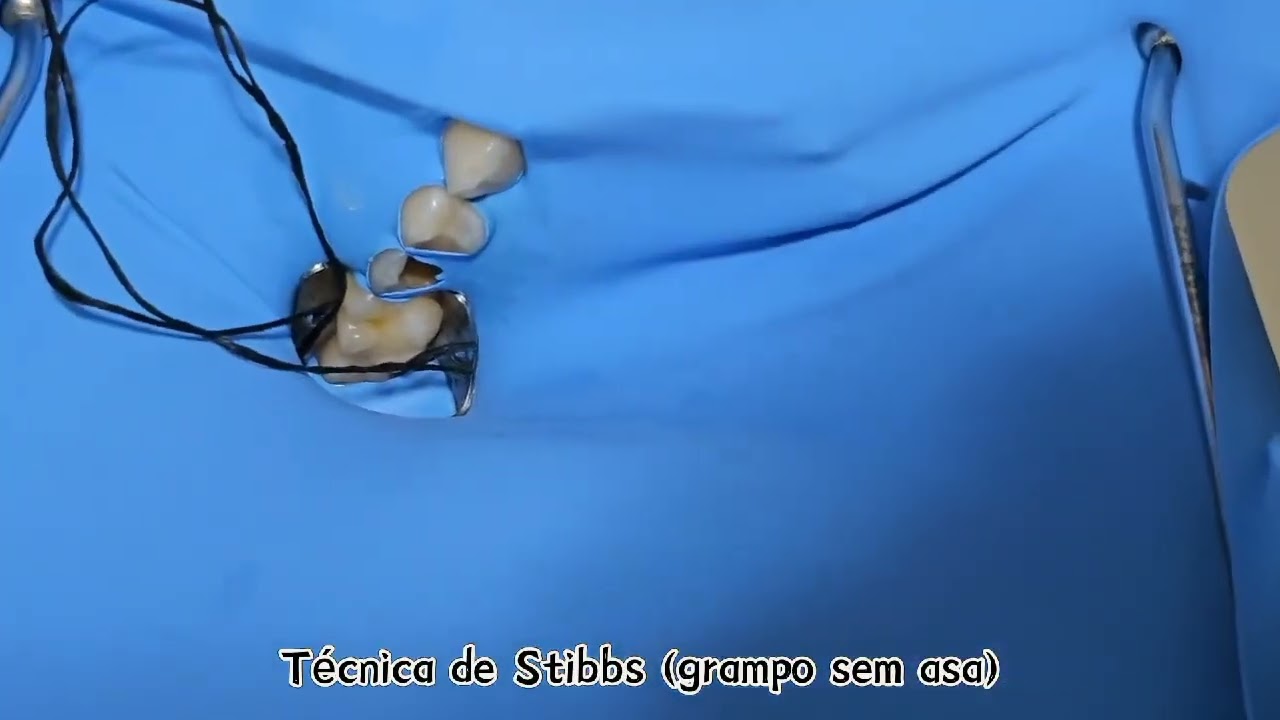 Isolamento Absoluto com a técnica de Stibbs, para elevação de margem gengival.