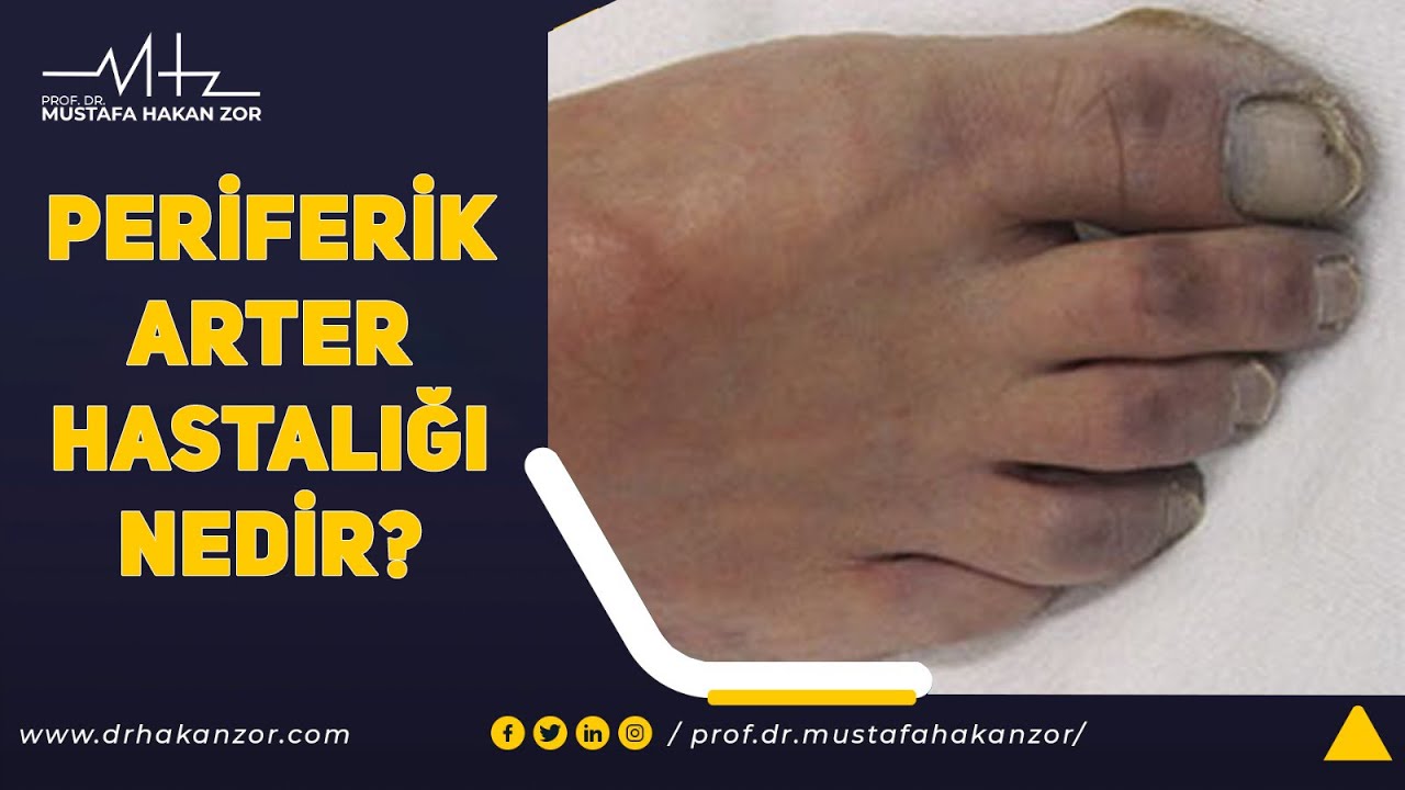Periferik Arter Hastalığı Nedir? Periferik Arter Hastalığı Belirtileri Nelerdir?