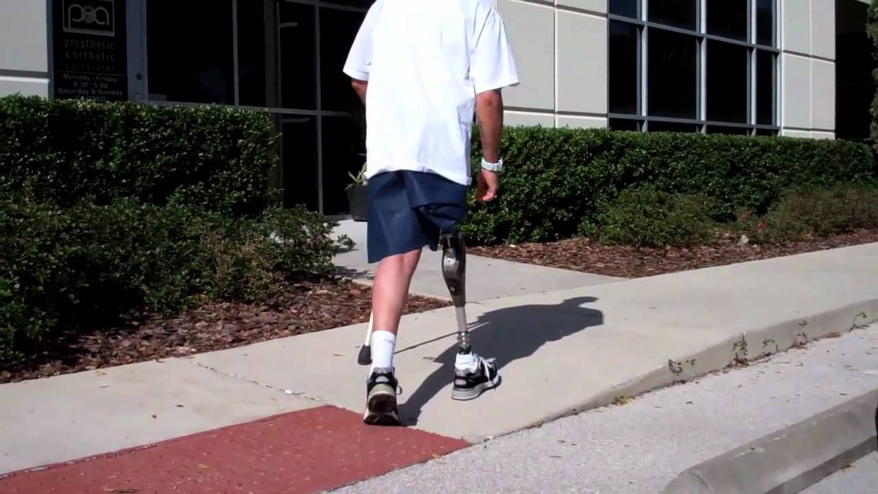 Hip Disarticulation and Hemi-Pelvectomy amputee stories