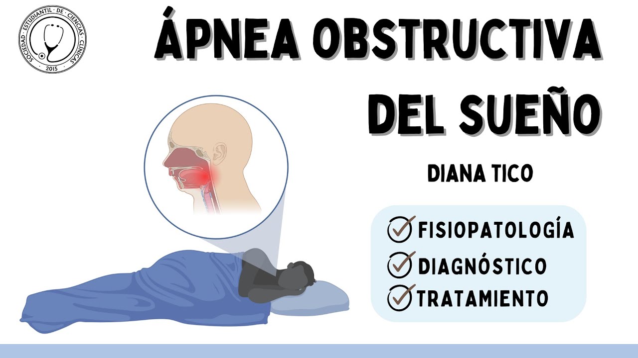 ÁPNEA OBSTRUCTIVA DEL SUEÑO: Fisiopatología, Clínica, Diagnóstico y Tratamiento