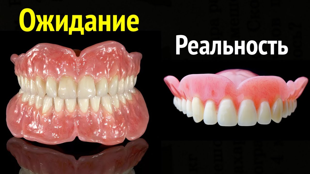 ПРИМЕРКА - этап, где ВСЁ решается!) ............ #съёмныепротезы #протезированиезубов #стоматология