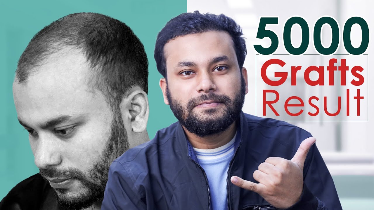 Grade 5 Baldness Hair Transplant in Bangladesh | Best Before and After Result