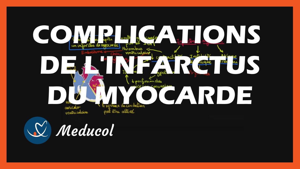 Conséquence et complications de l'infarctus du myocarde (crise cardiaque): Post-infractus