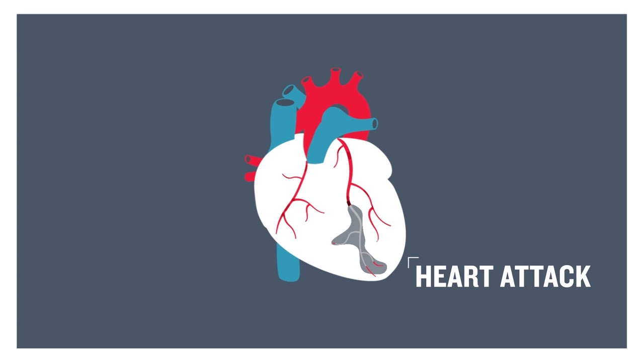 Heart attack, clogged arteries and atherosclerosis