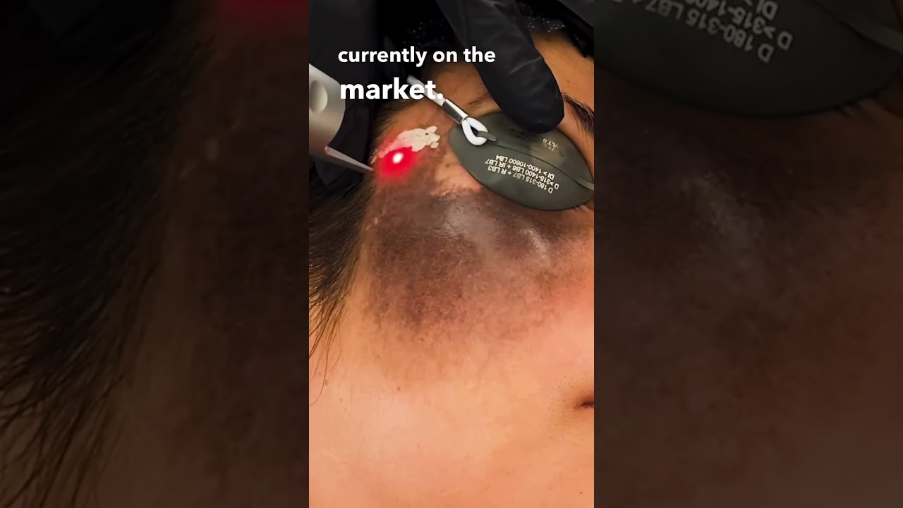 THIS Laser Can Erase Birthmarks! (Birthmark Treatment/Hyperpigmentation)  #laserskincare