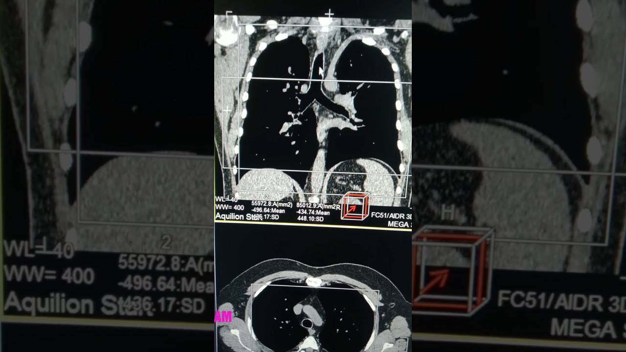 Pulmonary angio & By Mr_Mohamed abdou