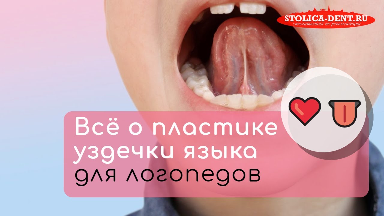 Когда нужна коррекция уздечки языка? ✔️ Запись вебинара «Логопеду – про уздечки»
