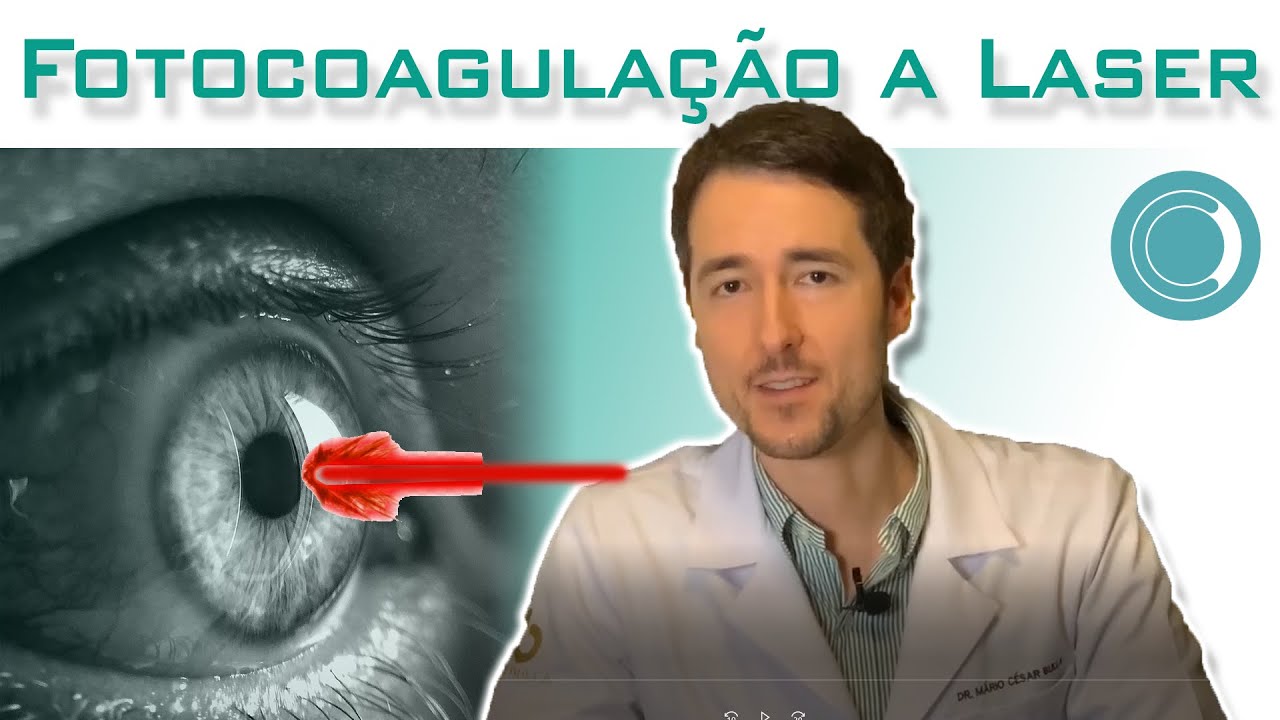 Fotocoagula&ccedil;&atilde;o a laser para doen&ccedil;as da retina