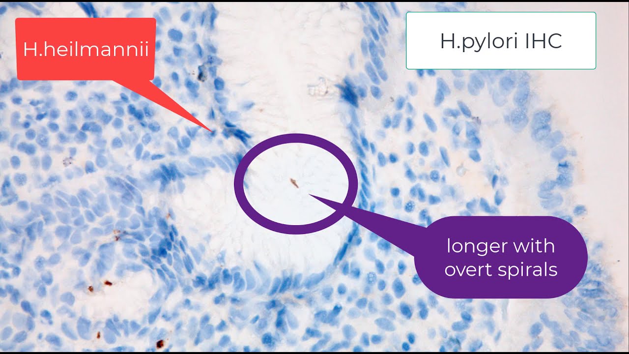 Histology of Helicobacter pylori gastritis