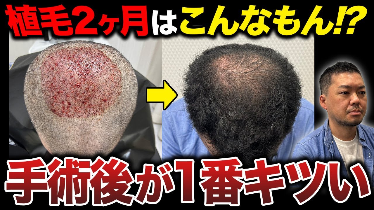 【30代薄毛】植毛から2ヶ月経過しても今が1番キツいのはなぜ？