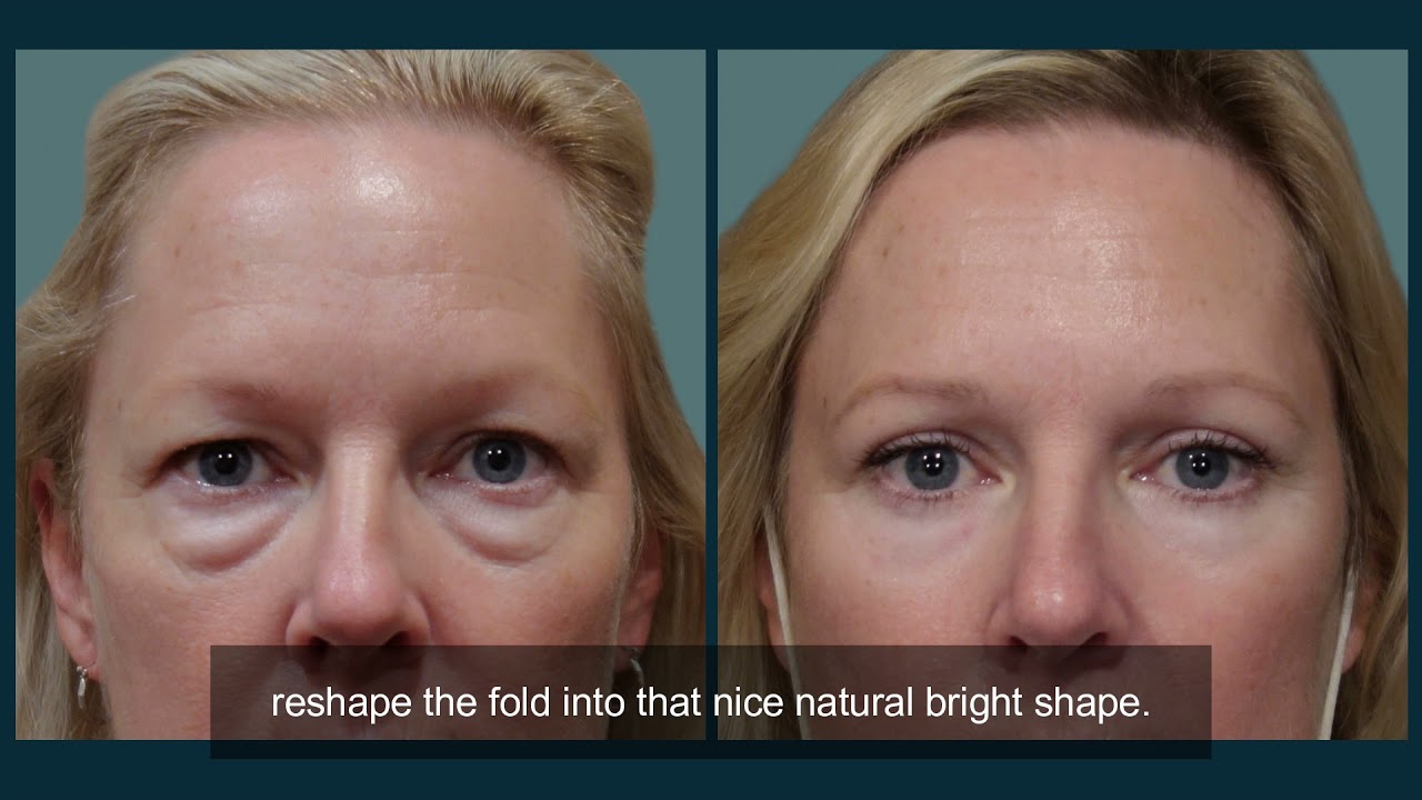 Upper Eyelid Blepharoplasty Surgery Explained
