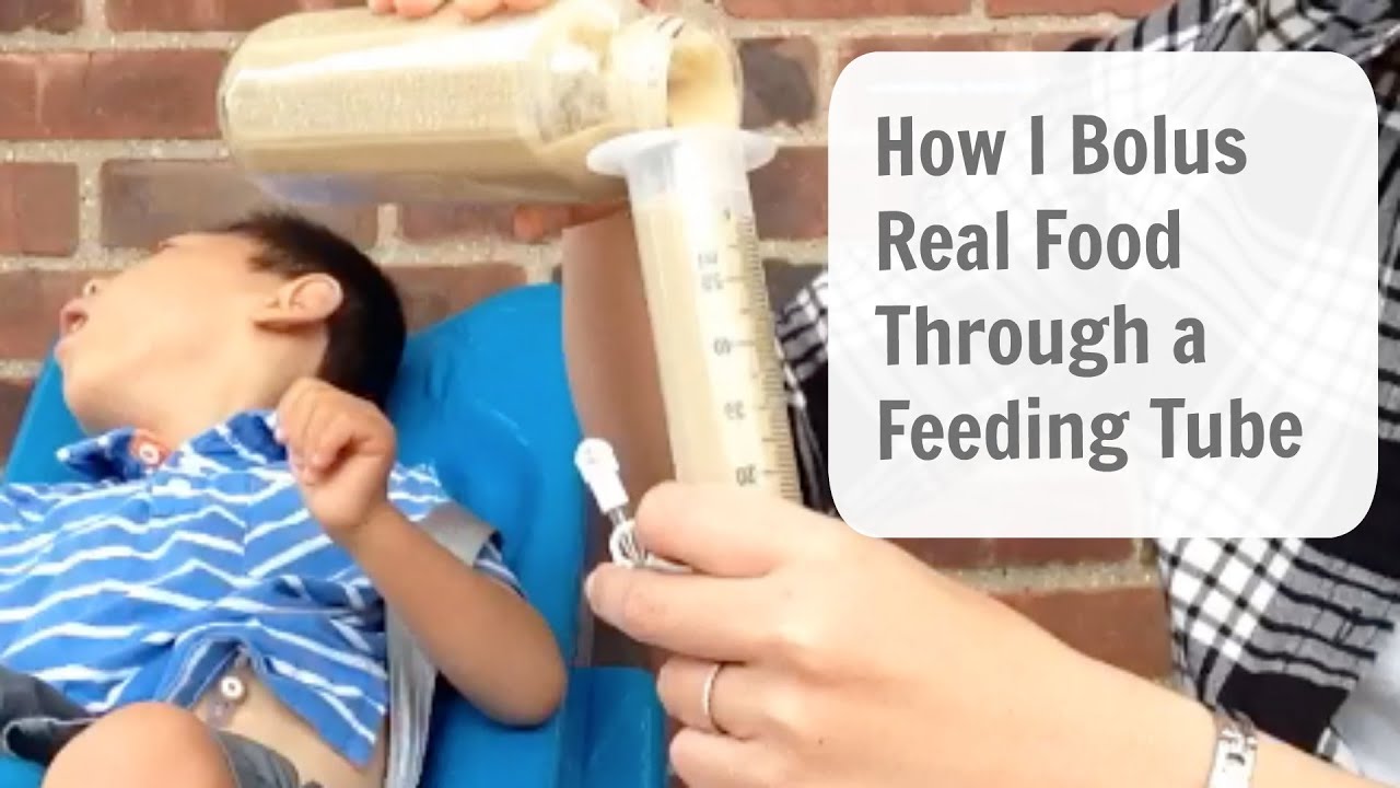 How to Bolus Feed Through a G-Tube (REAL FOOD)