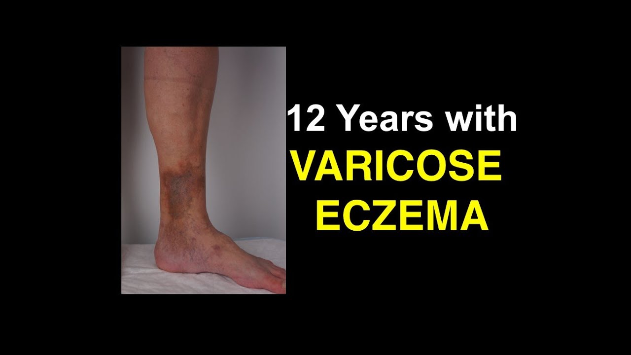12 Years With Varicose Eczema - Shocking Lessons