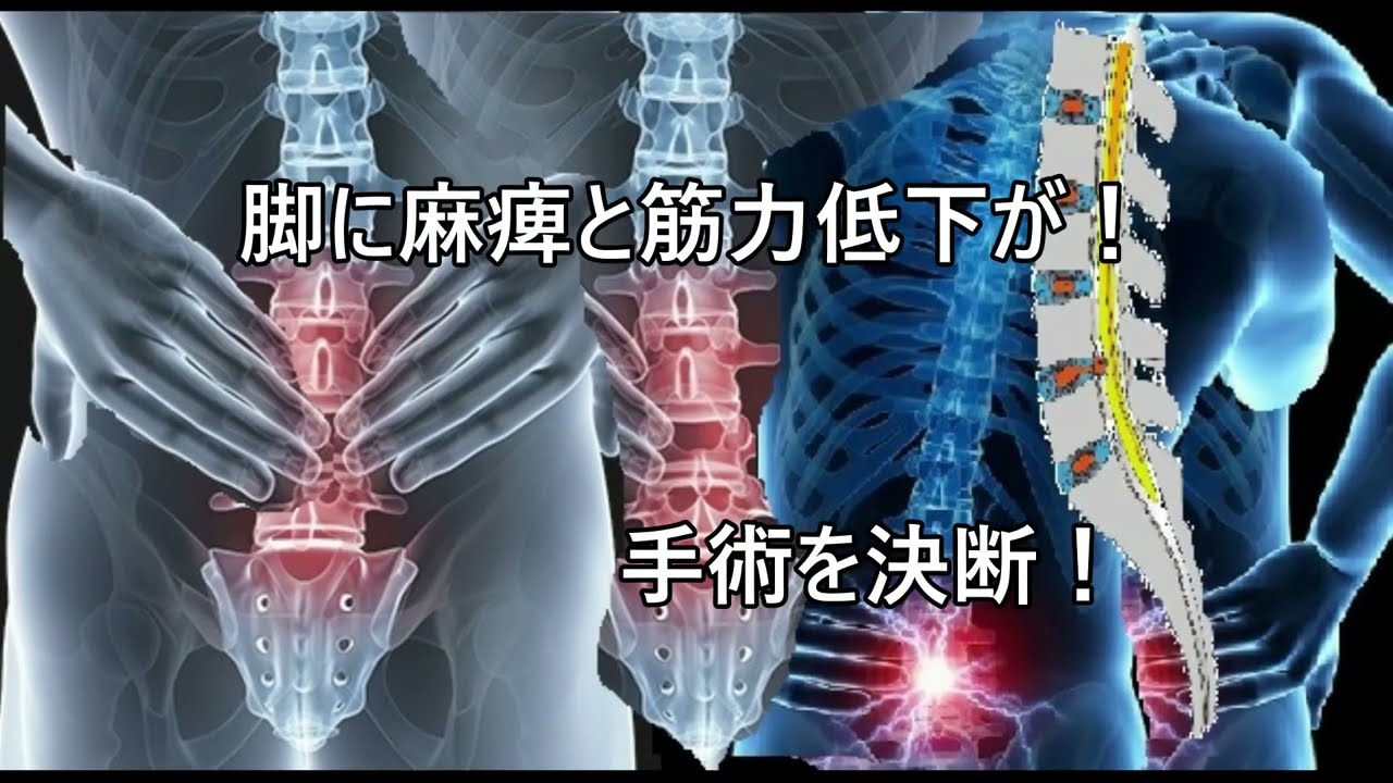 腰椎椎間板ヘルニア内視鏡手術決行