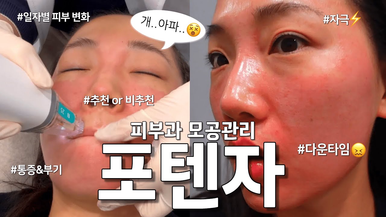 포텐자 시술 전에 꼭 보고 가세요.(진심) 가장 후회하는 시술..😫