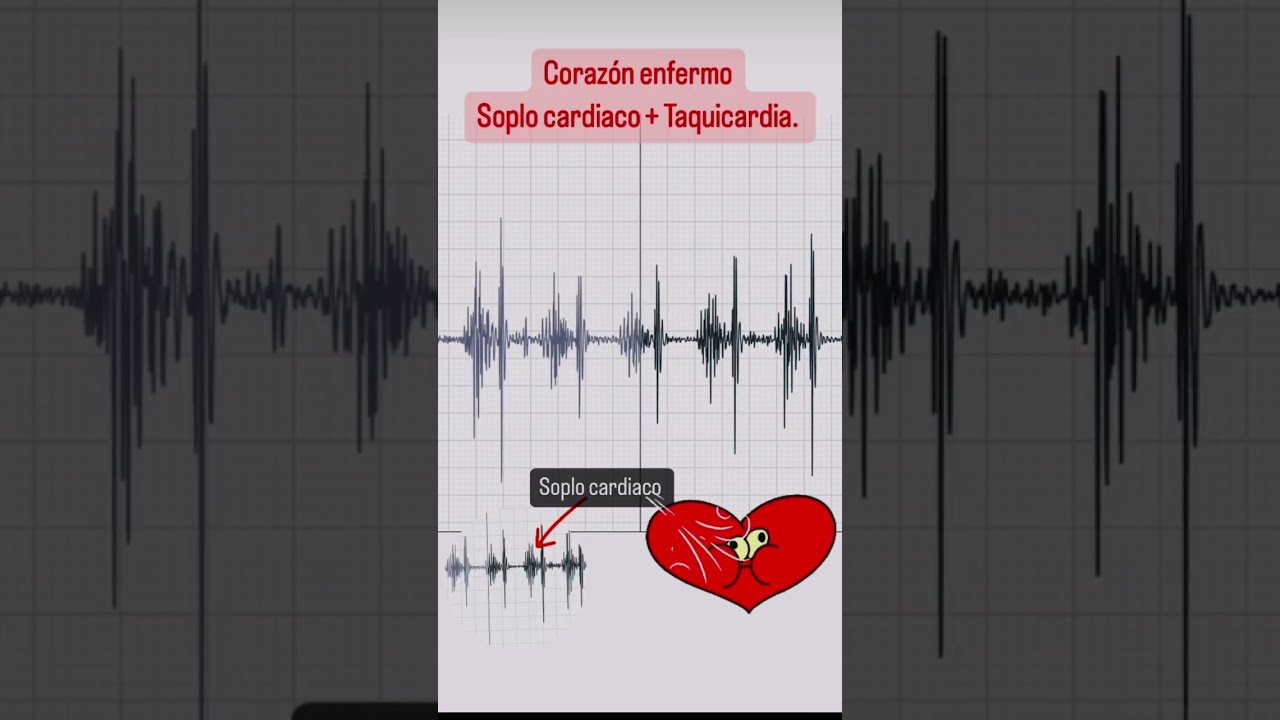 AUD&Iacute;FONOS 🎧👌🏽. #soplo #soplocardiaco #cardiologo #faltadeaire #palpitaciones