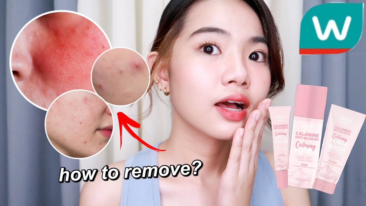AFFORDABLE SKINCARE FOR OILY, SENSITIVE AND ACNE PRONE SKIN! ft. FRESH CALAMINE SKINCARE SET!