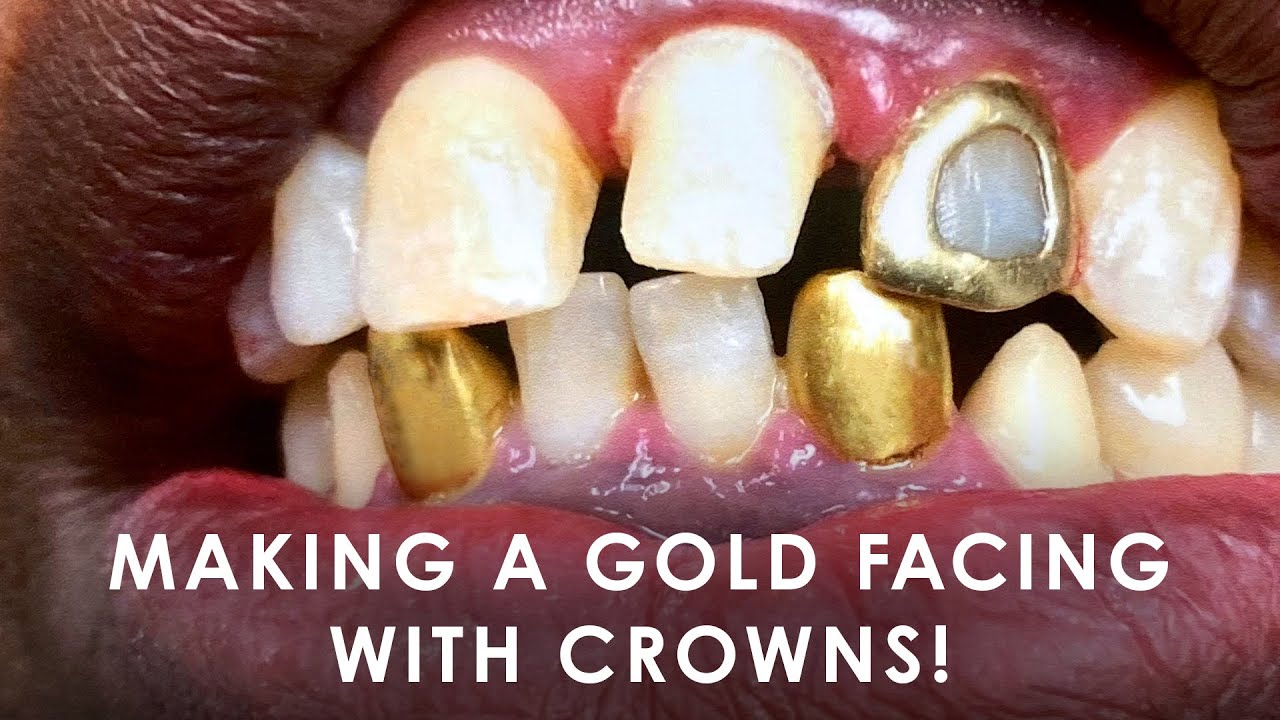 How to make a Gold Facing with Canine Crowns