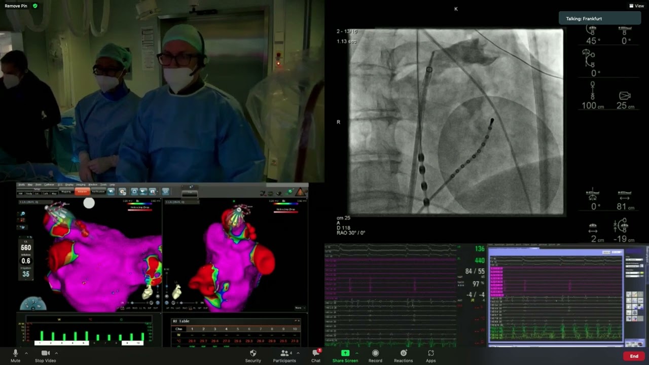 PR 2022, APRIL 25, Live demonstrations III – AF and atrial tachycardia ablation, Part D