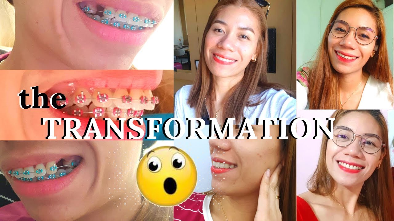BEFORE AND AFTER BRACES | TRANSFORMATION | NABAGO TALAGA ANG NGIPIN KO | Part 1