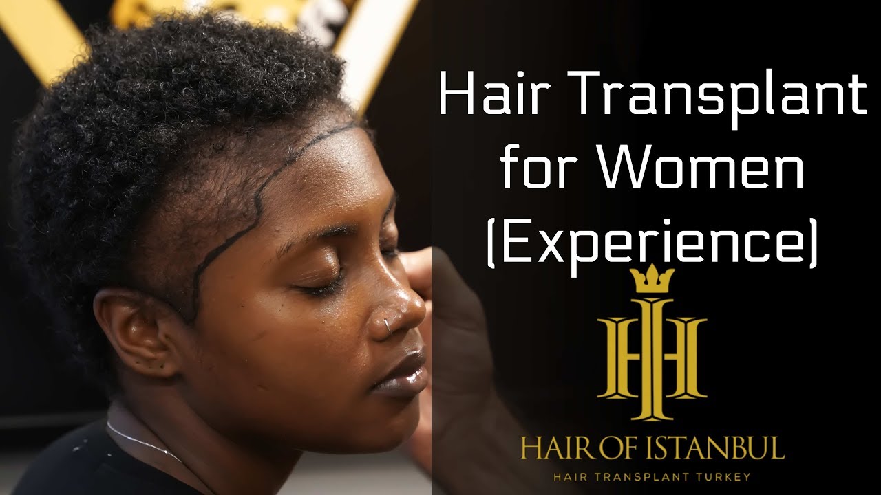 Hair Transplant Turkey: for Afro-American Ladies (Review)