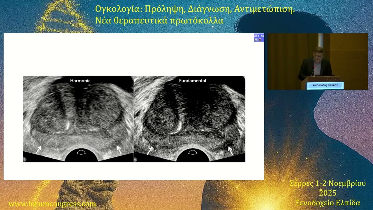 Καρκίνος του προστάτη - Νεότερα δεδομένα  Απόστολος Γιούρης