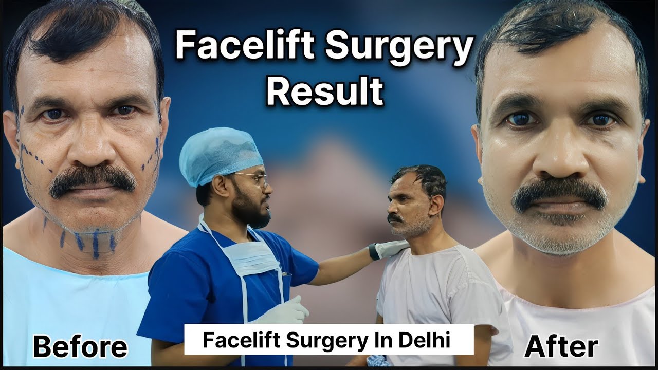 Facelift Surgery In Delhi | Facelift Surgery Cost in Delhi India | Zenith Clinic.