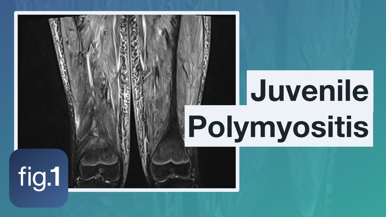 How do you diagnose Juvenile Polymyositis?