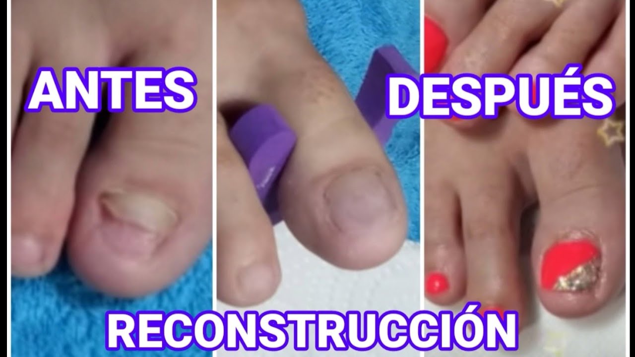 Reconstrucción de uña del pie, cambio total!. Nail reconstruction, total change!