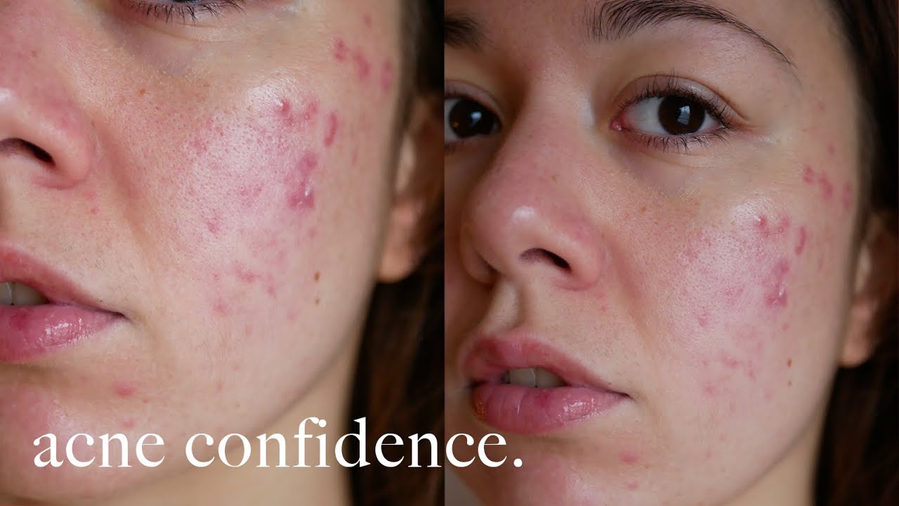 ACNE POSITIVITY: how to stop hating your skin