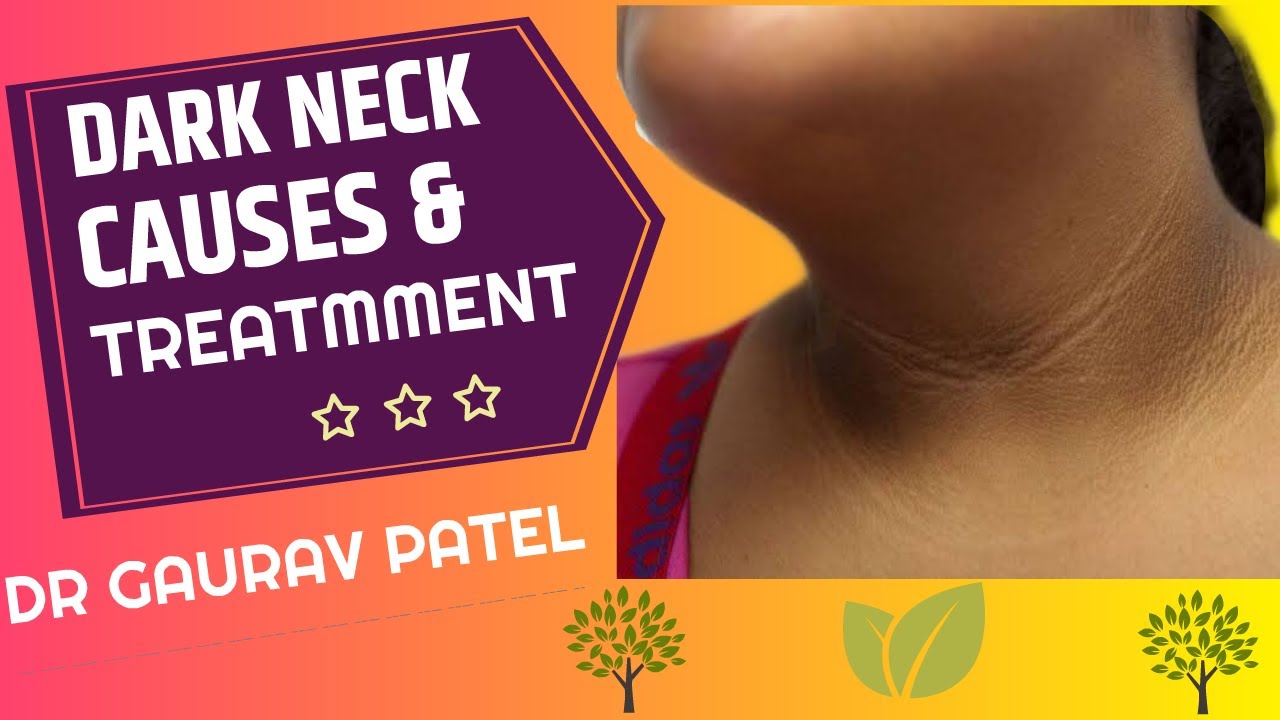 Dark neck problem - Reasons and treatment