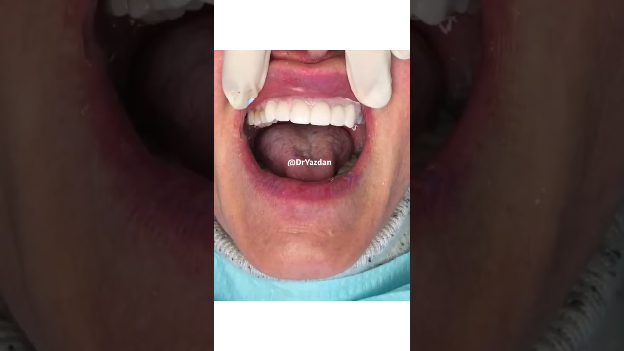 Full mouth rehabilitation | full mouth crowns before and after | dental crowns procedure | Dr.Yazdan