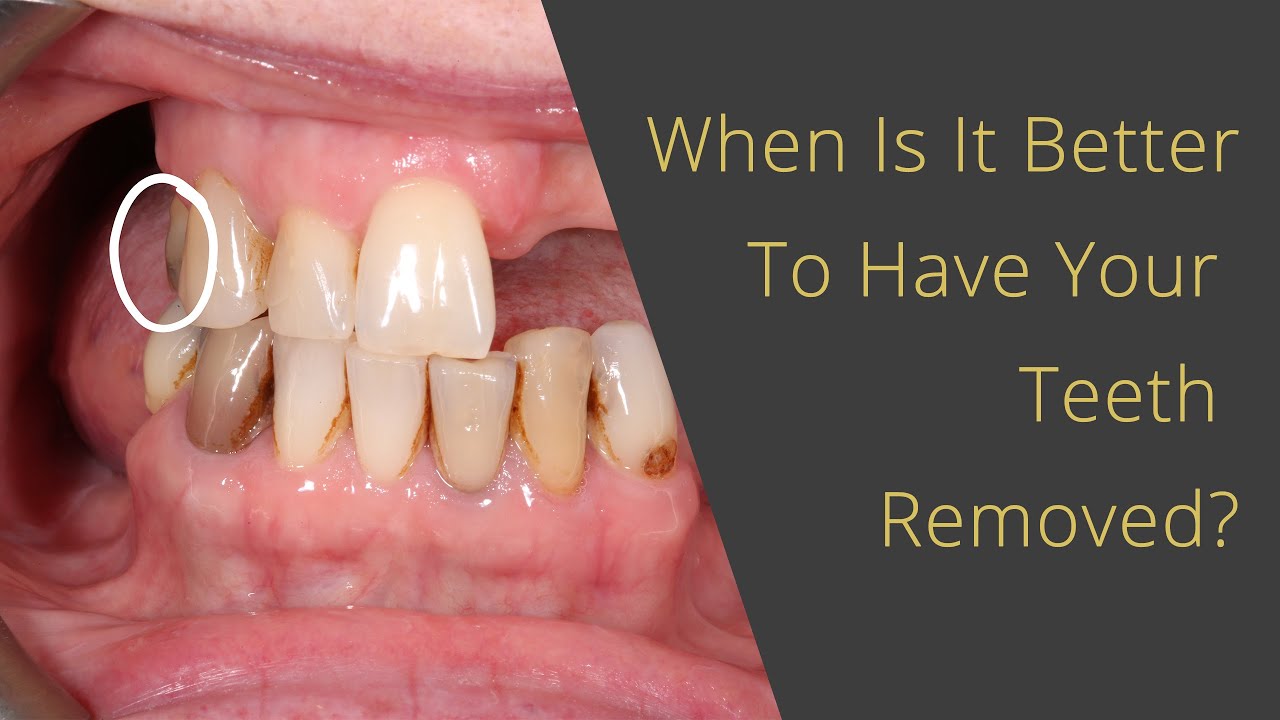When Is It Better To Remove Your Teeth (for all on 4 Dental Implants - for example!)