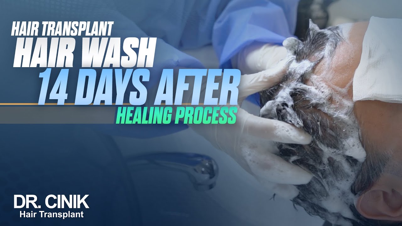 Dr.Cinik Hair Transplant | 14 Days Hair Wash After Healing Process