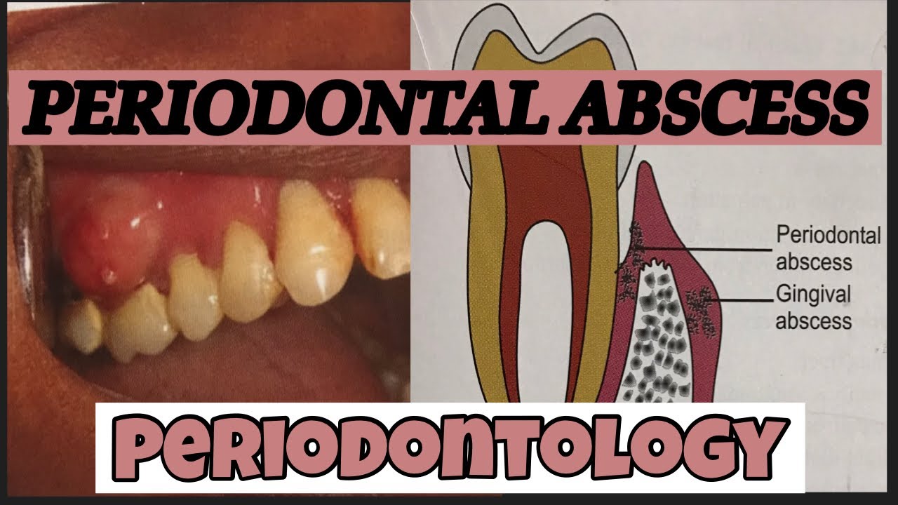 PERIODONTAL ABSCESS II PERIODONTOLOGY