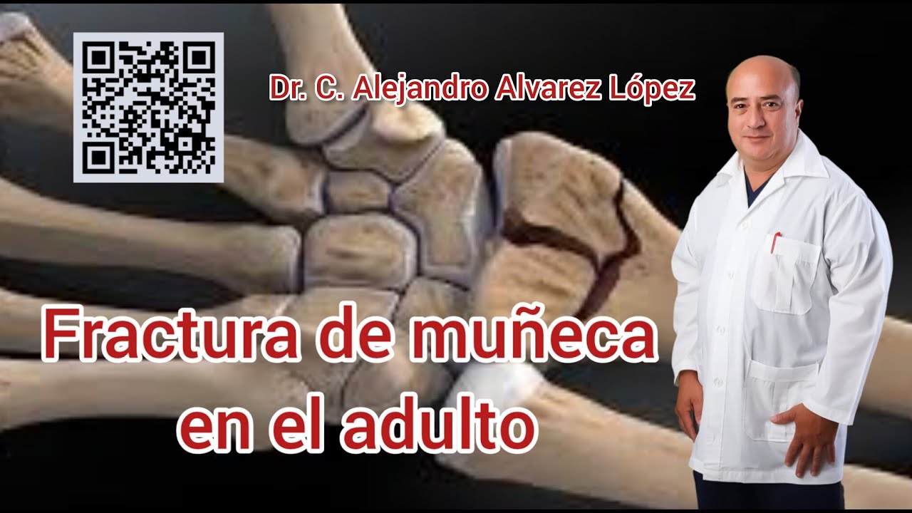 Fractura de muñeca en el adulto