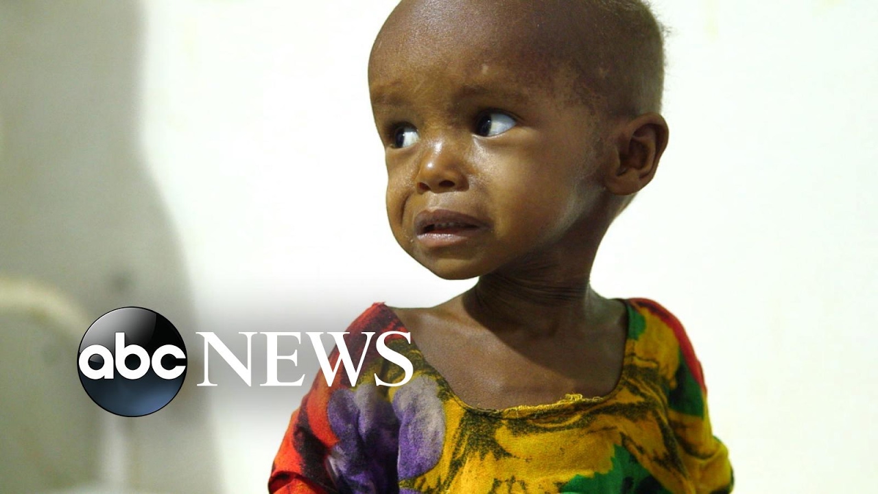 Children in Somalia are malnourished and fighting for their lives