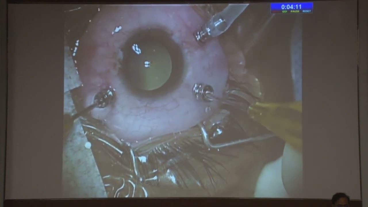 AIOC2022 GP191 topic  Dr Lily Rajbanshi An experience with the Ocular cysticercosis video presentati