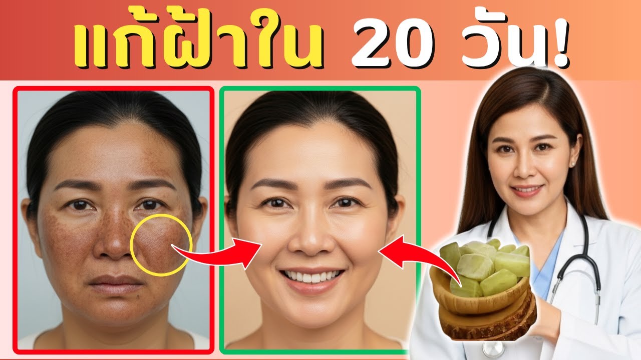 บอกลาฝ้า | วิธีรักษาฝ้า กระ และจุดด่างดำด้วยวิธีธรรมชาติ
