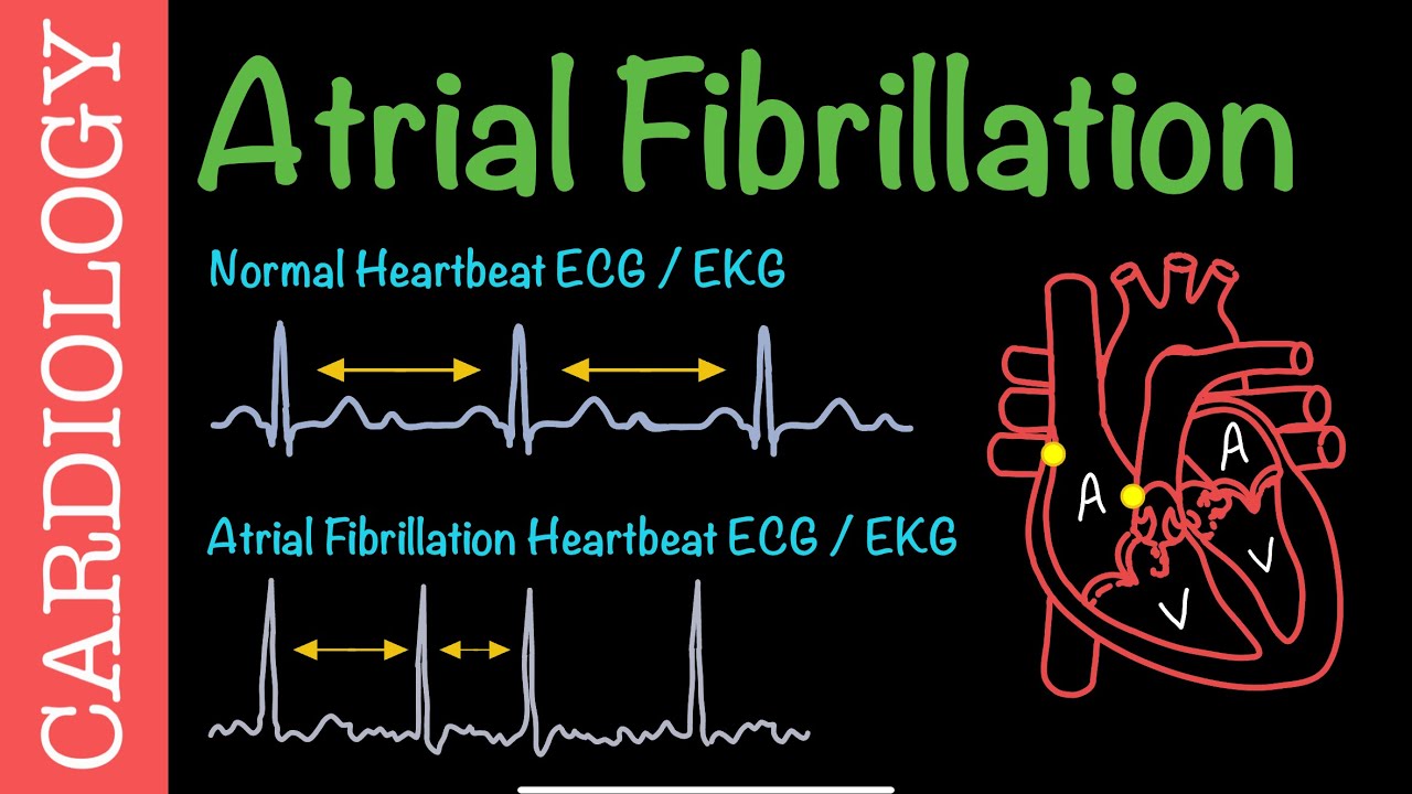 Atrial Fibrillation | Cardiovascular Pathophysiology
