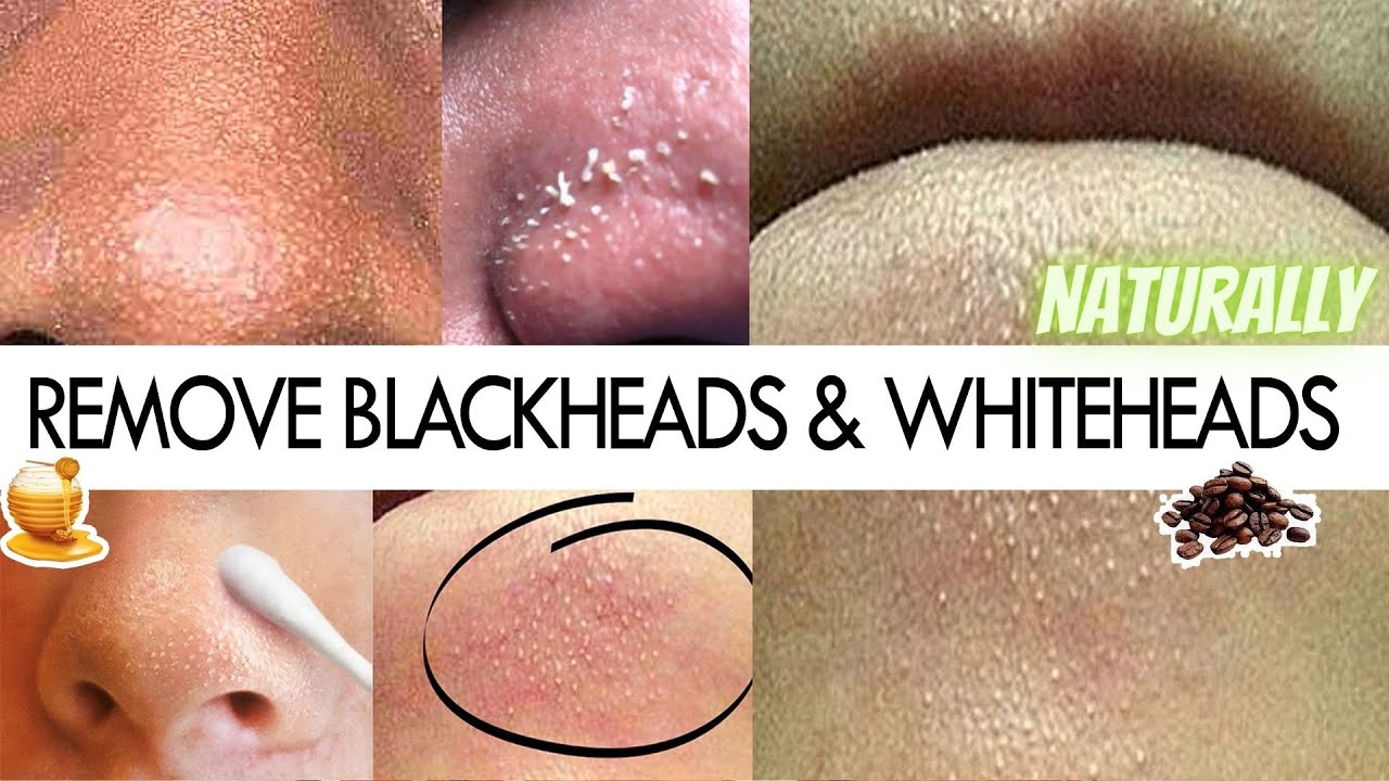 HOW TO REMOVE BLACKHEADS & WHITEHEADS | Natural Coffee Scrub for clogged pores
